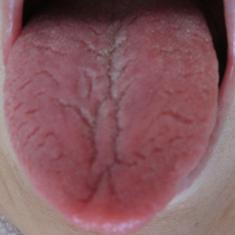 舌は健康のサイン 白い舌 が意味するのは この差って何ですか